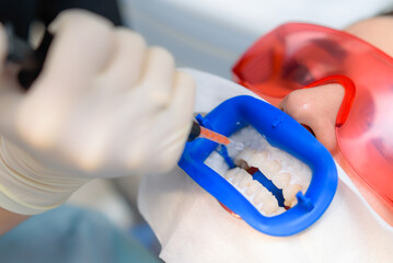 Preparing the oral cavity for whitening with an ultraviolet lamp. Close-up