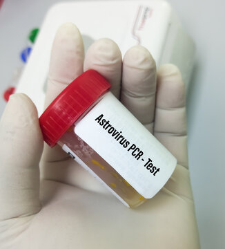 Laboratory Scientist Hold Stool Sample For Astrovirus PCR Test, Health And Medical Concept. Fecal Virus Test.