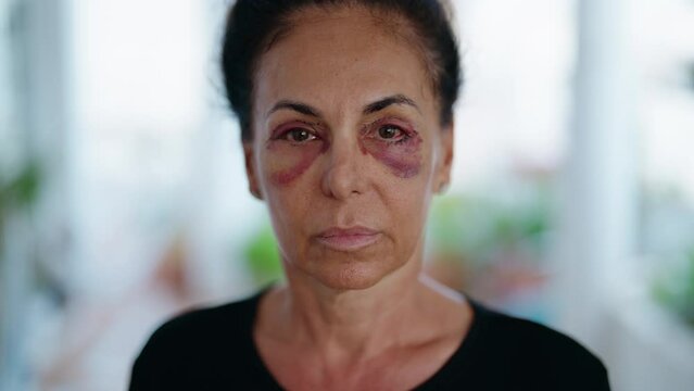 Middle age hispanic woman suffering for domestic violence with bruise on eyes at home terrace