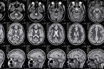 High resolution magnetic resonance image scan of brain epi syndrome. Real MRI scan of head, close...