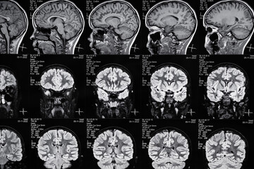 High resolution magnetic resonance image scan of brain epi syndrome. Real MRI scan of head, close...