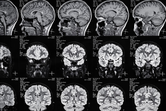 High resolution magnetic resonance image scan of brain epi syndrome. Real MRI scan of head, close up.