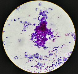 Intra abdominal mass(Cytology): Spindle cell sarcoma, positive malignant cells. Pleomorphic...