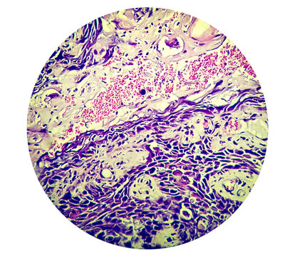 Squamous Papilloma Of Lamber Spine Area To The Human Papilloma Virus (HPV), Squamous Cell Papilloma, Benign Growth