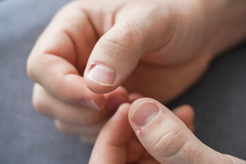 Men's manicure at home. Cut fingernails. Fingernails close-up. Untrimmed nails, burrs on the fingers, untidy manicure.