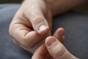Men's manicure at home. Cut fingernails. Fingernails close-up. Untrimmed nails, burrs on the fingers, untidy manicure.