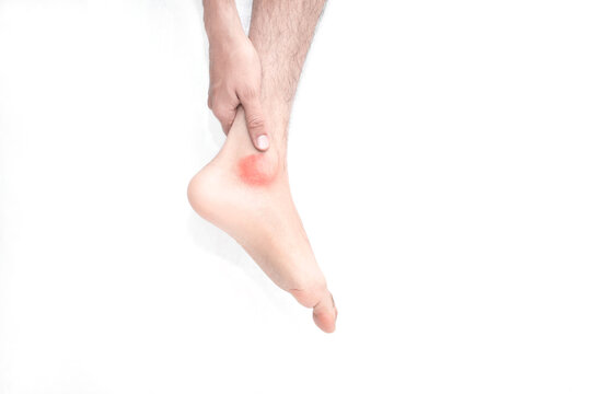 Tobillo rojizo adolorido por un esguince pie lastimado joven tocando su pierna lesionada