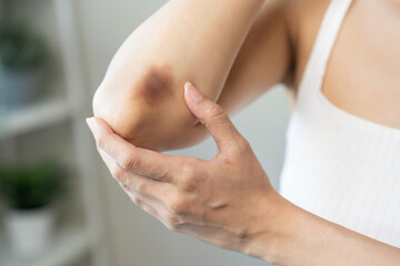Close up of stain bruise wound on arm, contusion asian young woman, girl an accident fell down...