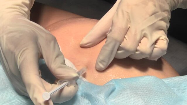 Surgeon makes an incision in the skin of the patient's buttocks with a scalpel. The procedure for inserting pills under the skin in the clinic