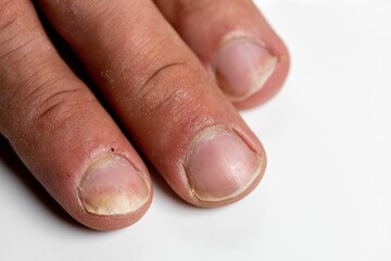 Closeup of the fingers of a patient with Psoriatic onychodystrophy or psoriatic nails disease