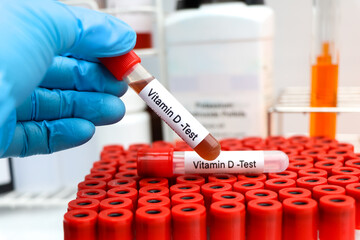 Blood samples for testing vitamin D in the laboratory