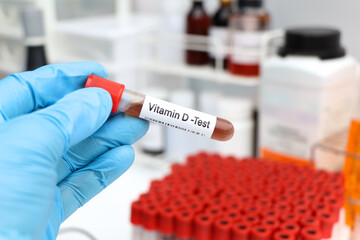 Blood samples for testing vitamin D in the laboratory
