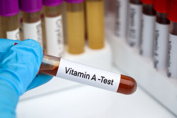 Blood samples for testing vitamin A in the laboratory