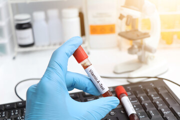Blood samples for testing vitamin A in the laboratory
