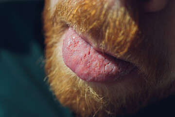 Bacterial infection disease tongue in a man.