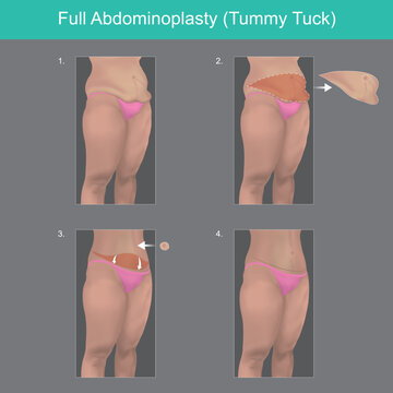 Full Abdominoplasty. Explain to understand on steps a surgery out of body belly fat..