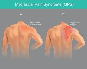 Trigger points Pain Syndrome. The back chronic pain disorder in a human shoulder area. Illustration infographic..