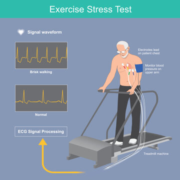 Exercise Stress Test. Older Man The Heart Beat Test On Electric Treadmill And Results Electric Signal Waveform Display On Monitor..