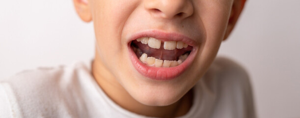 The child has a gap between the front teeth. The concept of orthodontic and stomatology