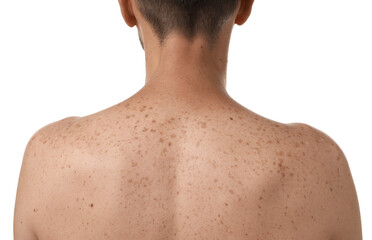 Closeup of man`s body with birthmarks on white background, back view