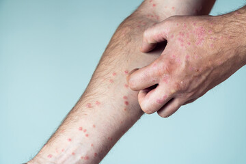 Cropped photo of man suffering from psoriasis scratching thick scaly clusters, red rash on skin of arm with fingers.