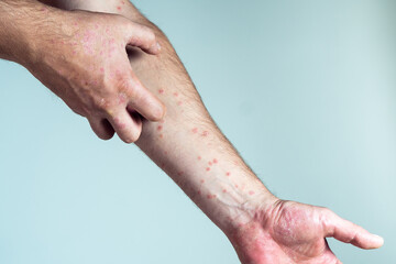Fototapeta premium Unrecognizable man suffering from psoriasis scratching thick clusters, flaky rash on skin of arm with affected fingers.