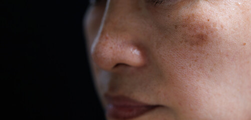 melasma on woman face. isolated  on dark background