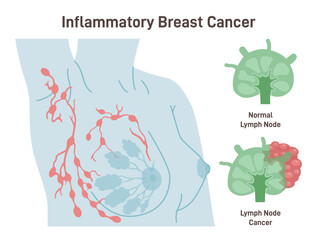 Inflammatory breast cancer. Detailed breast medical anatomy.