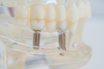 A model of teeth with implants lies on a table