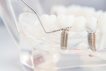 A model of teeth with implants lies on a table