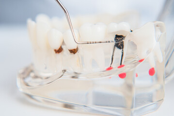 doctor orthodontist shows the instrument on caries in the teeth