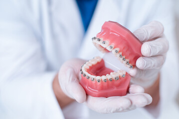 Fototapeta na wymiar doctor orthodontist shows how the system of braces on teeth is arranged