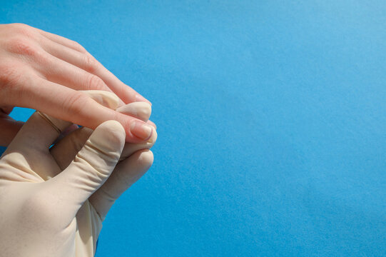 The doctor examines the affected nails - onycholysis, close-up on a blue background.
