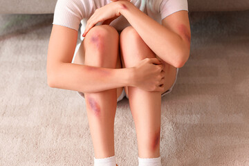 Young woman with bruises sitting on floor at home, closeup