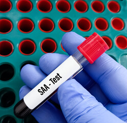 Blue glove hand holding a blood sample tube for Serum Amyloid A(SAA) test, early and sensitive blood biomarker for tissue injury and inflammation to indicated in many inflammatory diseases.