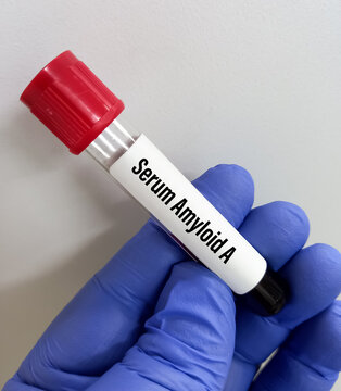 Blue Glove Hand Holding A Blood Sample Tube For Serum Amyloid A(SAA) Test, Early And Sensitive Blood Biomarker For Tissue Injury And Inflammation To Indicated In Many Inflammatory Diseases.