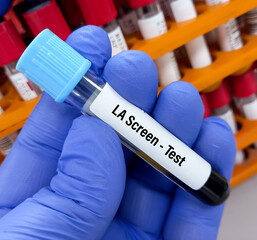 Lab Technologist hold blood sample for LA(Lupus Anticoagulant) Screen test. Laboratory medical...