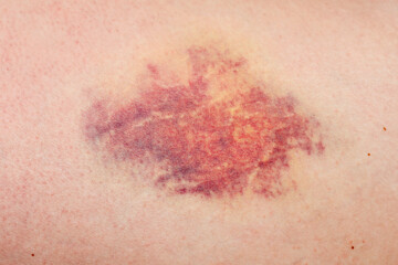 A bruise, a large hematoma on the human body
