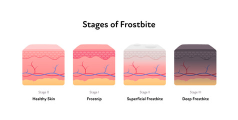Frostbite anatomical infographic poster. Vector flat medical illustration. Stages of hypothermia disease. Skin layer stage of healthy, frostnip, superficial and deep. Design for healthcare dermatology
