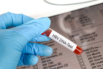  HBV DNA Test test to look for abnormalities from blood