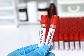  HBV DNA Test test to look for abnormalities from blood
