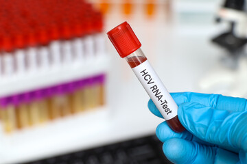 HCV RNA Test to look for abnormalities from blood