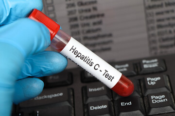 Hepatitis C Test to look for abnormalities from blood