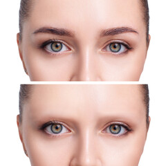 Young woman with bald eyebrows before and after hair transplantation.