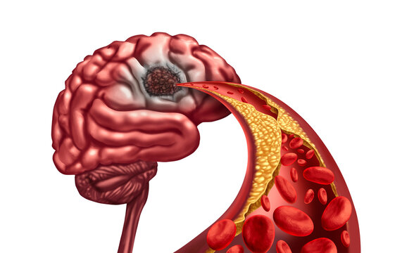 Vascular Dementia memory loss  brain loss, Brain, Liquefactive Necrosis, loss, blood circulation, mind, stroke, artery blockage, 