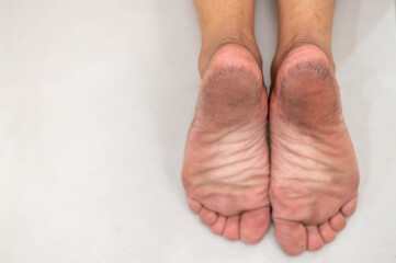 Feet with dry skin show an unhealthy foot. Must be often treatment in every day.