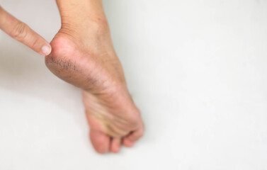 Feet with dry skin show an unhealthy foot. Must be often treatment in every day.