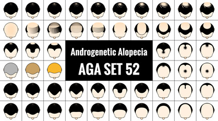 男性型脱毛症52種類。ハゲ頭のアイコン。AGA治療と薄毛の進行具合。ベクターイラスト。