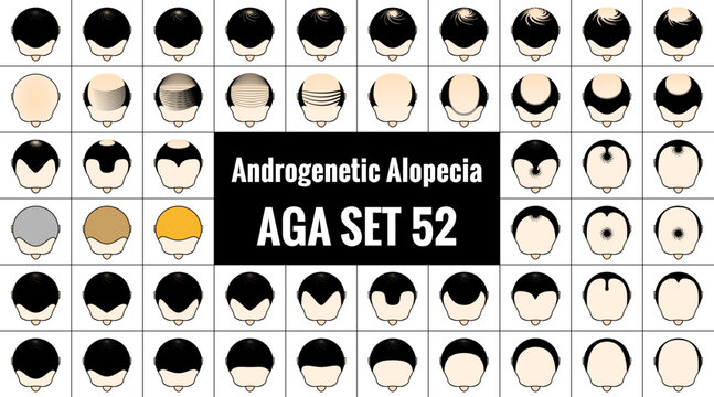男性型脱毛症52種類。ハゲ頭のアイコン。AGA治療と薄毛の進行具合。ベクターイラスト。