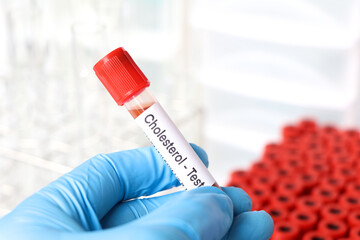 Cholesterol test to look for abnormalities from blood